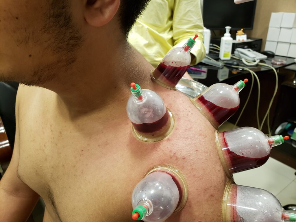 Chinese Cupping Therapy Hijama See Do Make